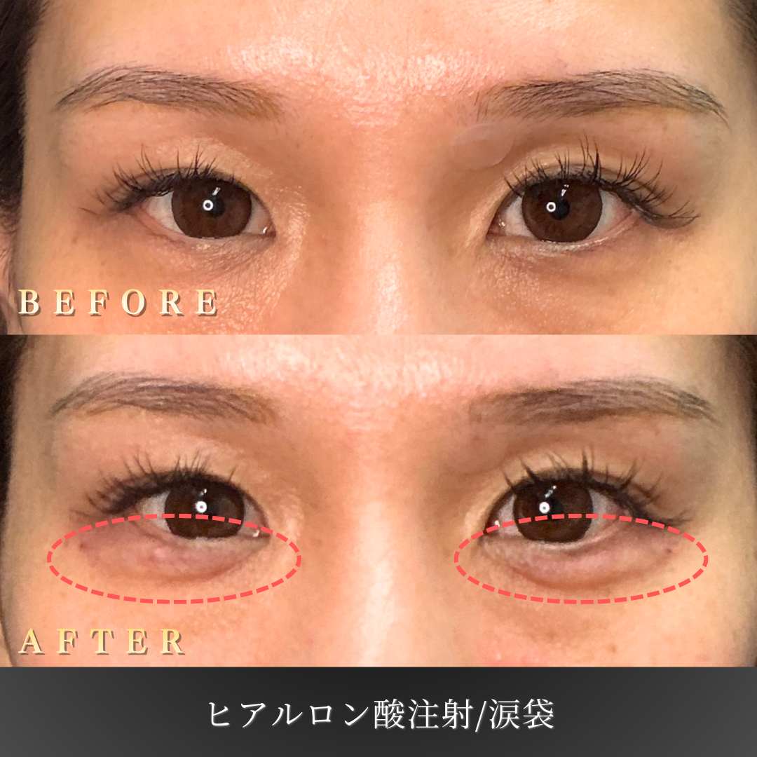 30代 涙袋ヒアルロン酸 症例写真〔正面Before/After〕｜大阪 心斎橋BiBiクリニック