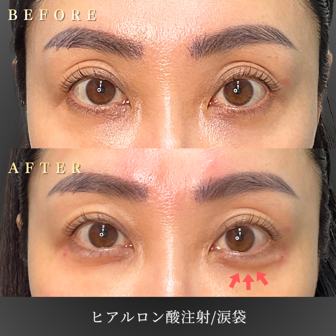 【40代女性】減ったボリュームを補う涙袋ヒアルロン酸症例｜大阪 心斎橋BiBiクリニックの症例写真