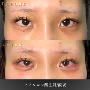 10代 涙袋ヒアルロン酸 症例写真〔正面Before/After〕｜大阪 心斎橋BiBiクリニック