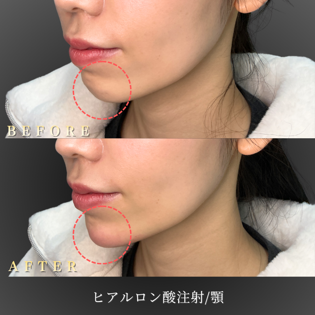 【20代女性】横顔に立体感を出す顎ヒアルロン酸症例｜大阪 心斎橋BiBiクリニックの症例写真