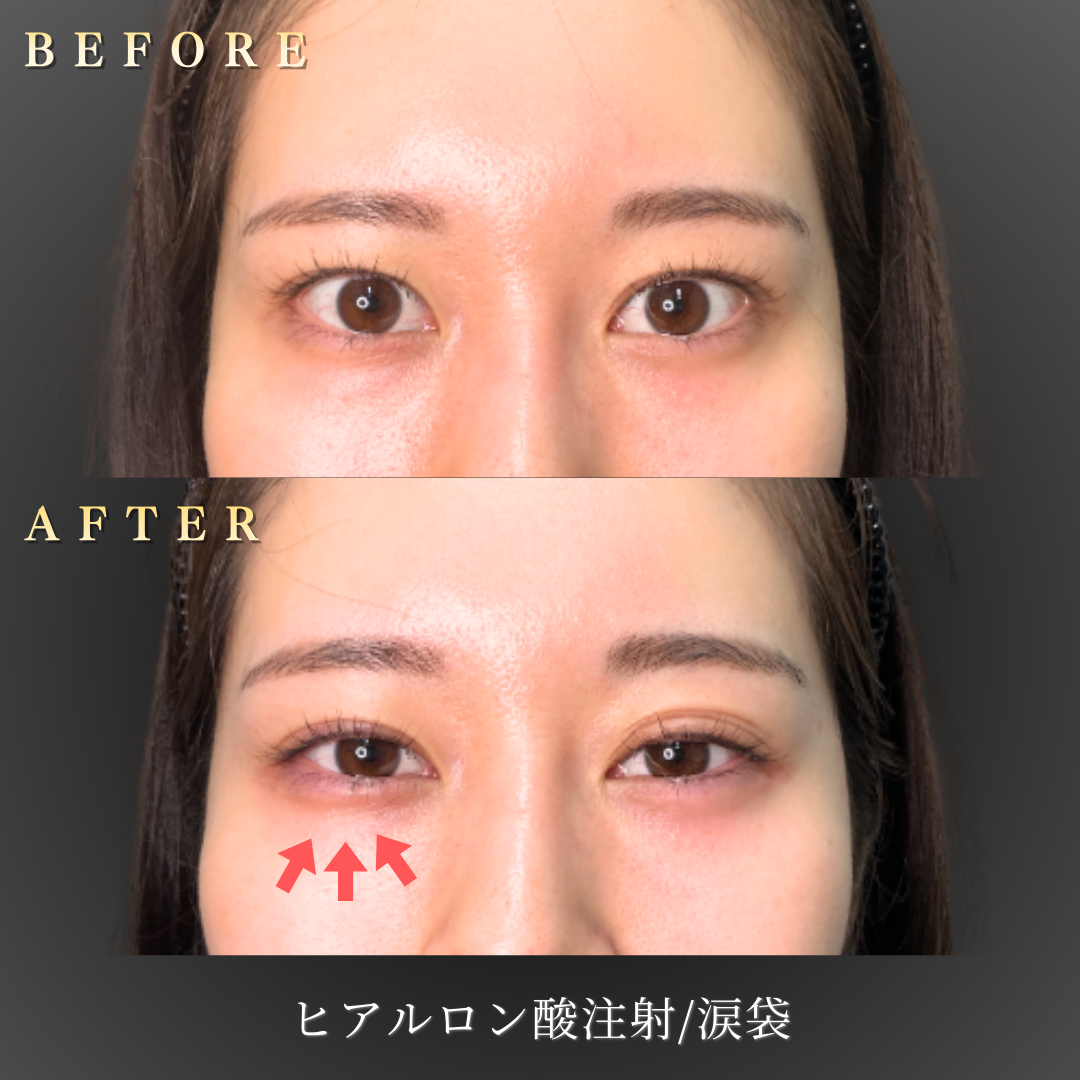 20代 涙袋ヒアルロン酸 症例写真｜大阪 心斎橋BiBiクリニック