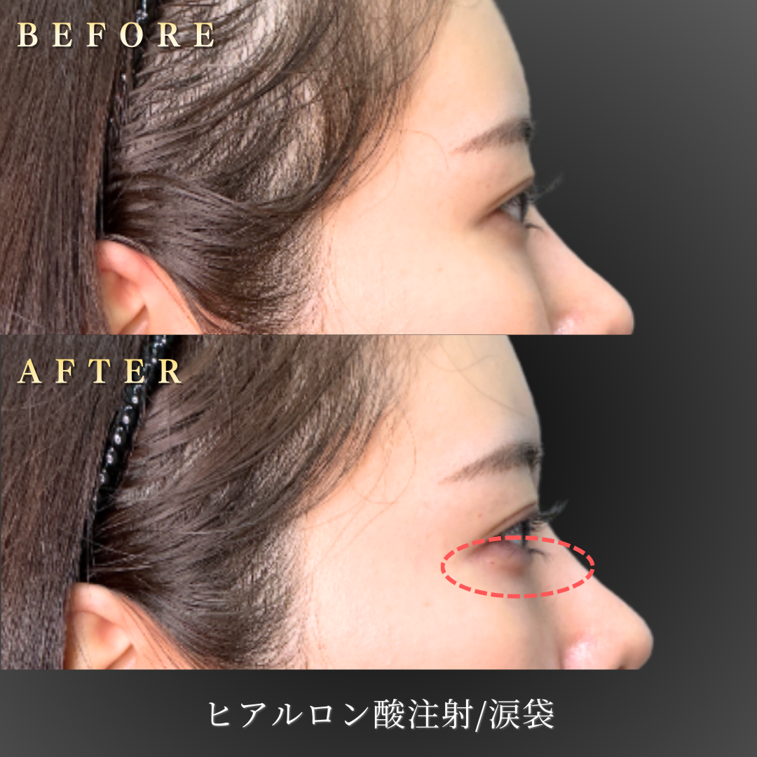 20代 涙袋ヒアルロン酸 症例写真〔右横Before/After〕｜大阪 心斎橋BiBiクリニック