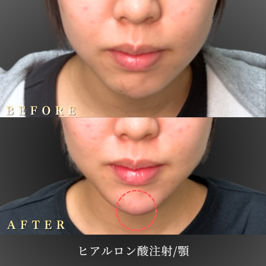20代 顎ヒアルロン酸 症例写真〔正面Before/After〕｜大阪 心斎橋BiBiクリニック