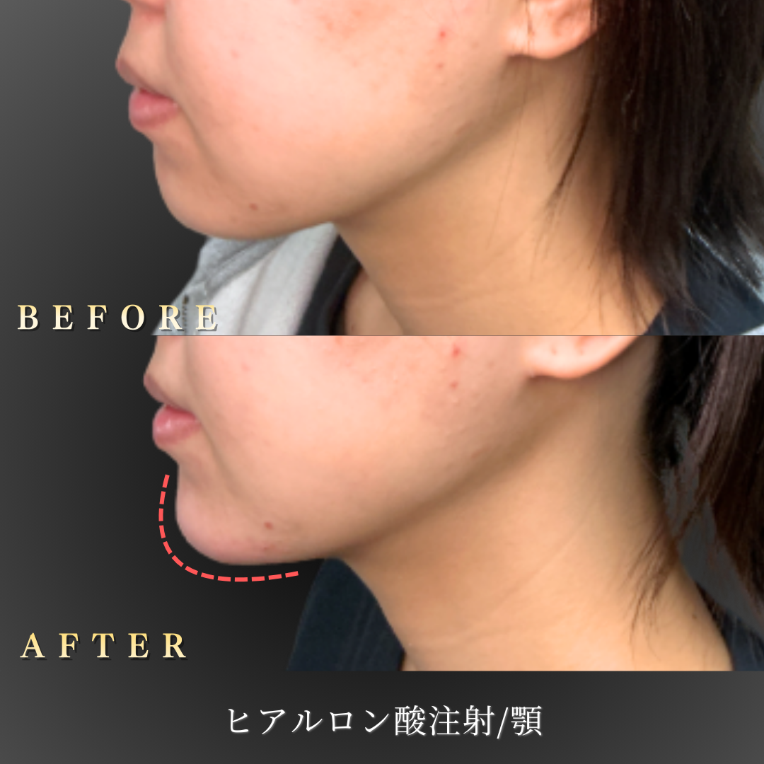 20代 顎ヒアルロン酸 症例写真〔左横Before/After〕｜大阪 心斎橋BiBiクリニック