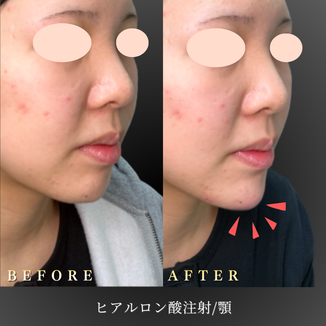 【20代女性】正面からも整って見える顎ヒアルロン酸症例｜大阪 心斎橋BiBiクリニックの症例写真
