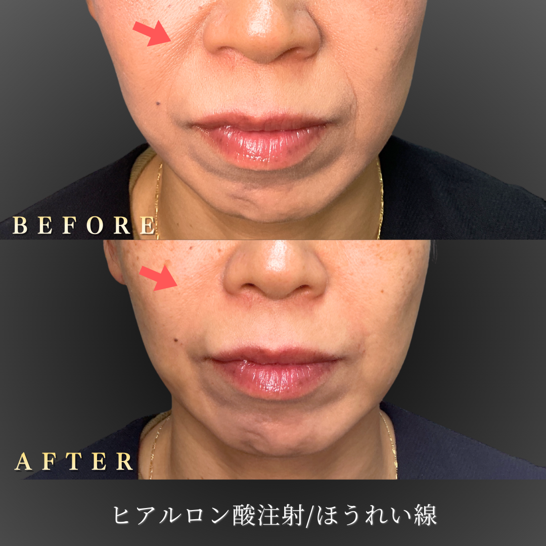 40代 ほうれい線ヒアルロン酸 症例写真〔正面Before/After〕｜大阪 心斎橋BiBiクリニック