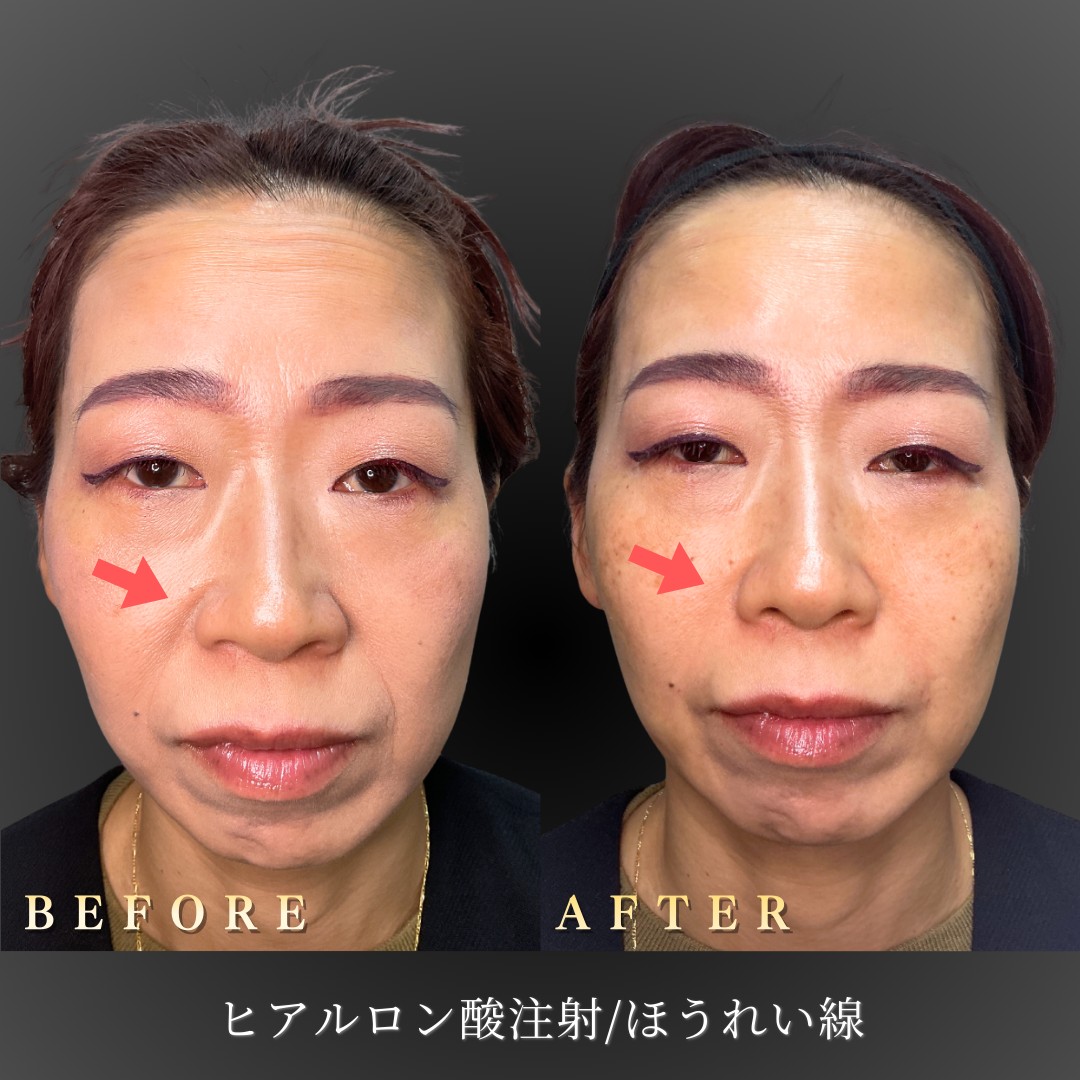 40代 ほうれい線ヒアルロン酸 症例写真〔正面Before/After〕｜大阪 心斎橋BiBiクリニック