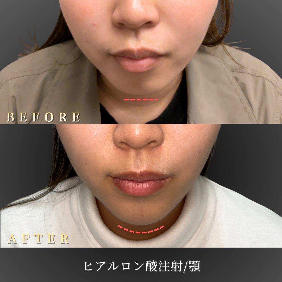 20代 顎ヒアルロン酸 症例写真〔正面Before/After〕｜大阪 心斎橋BiBiクリニック