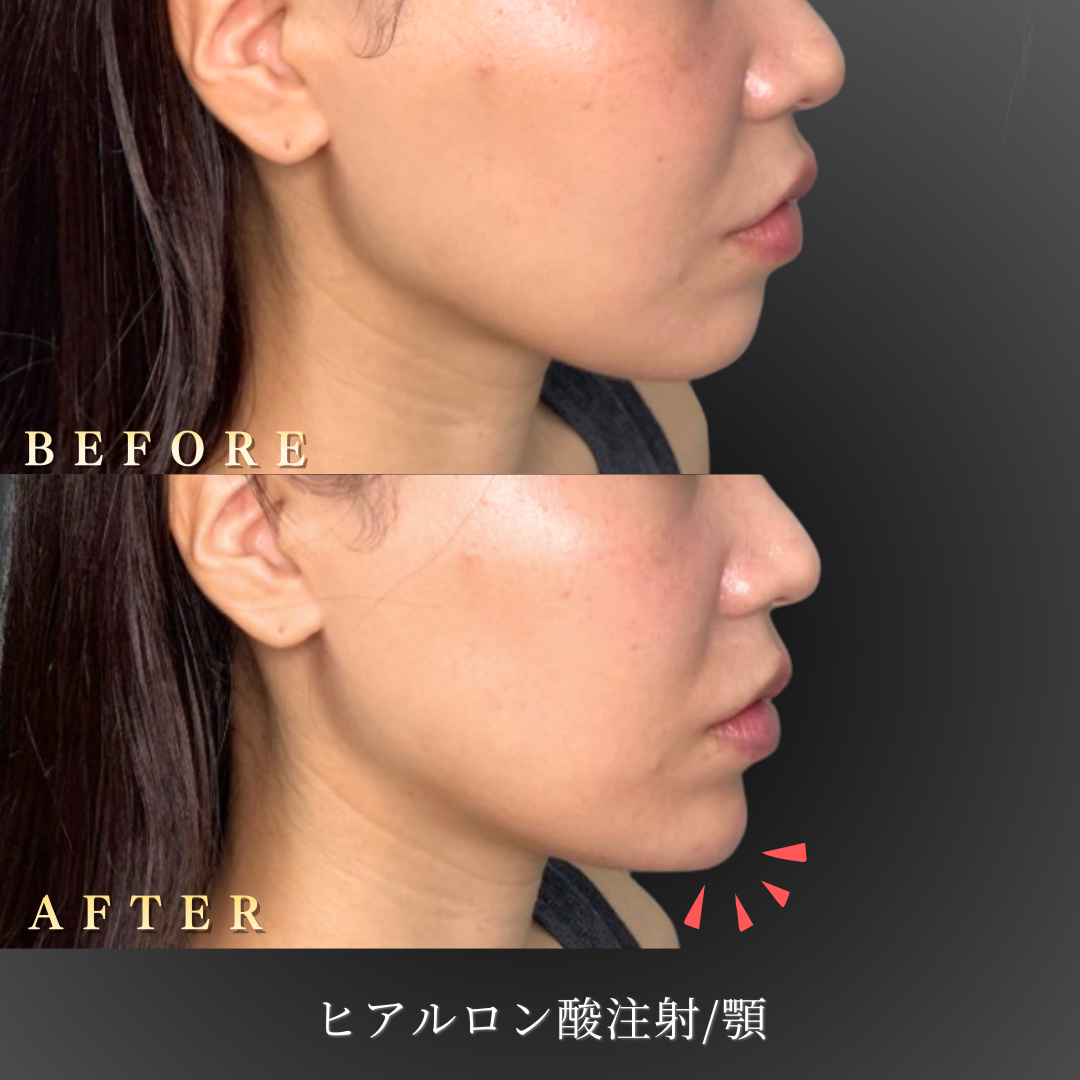 30代 顎ヒアルロン酸 症例写真〔右横Before/After〕｜大阪 心斎橋BiBiクリニック