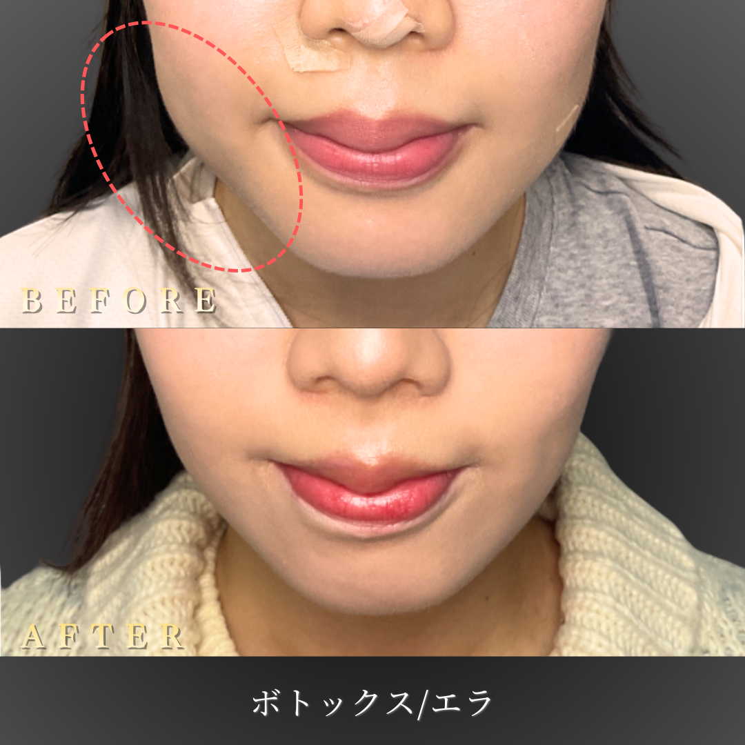 【サブ】20代 エラボトックス（食いしばり改善）症例写真〔左横Before/After〕｜大阪 心斎橋BiBiクリニック