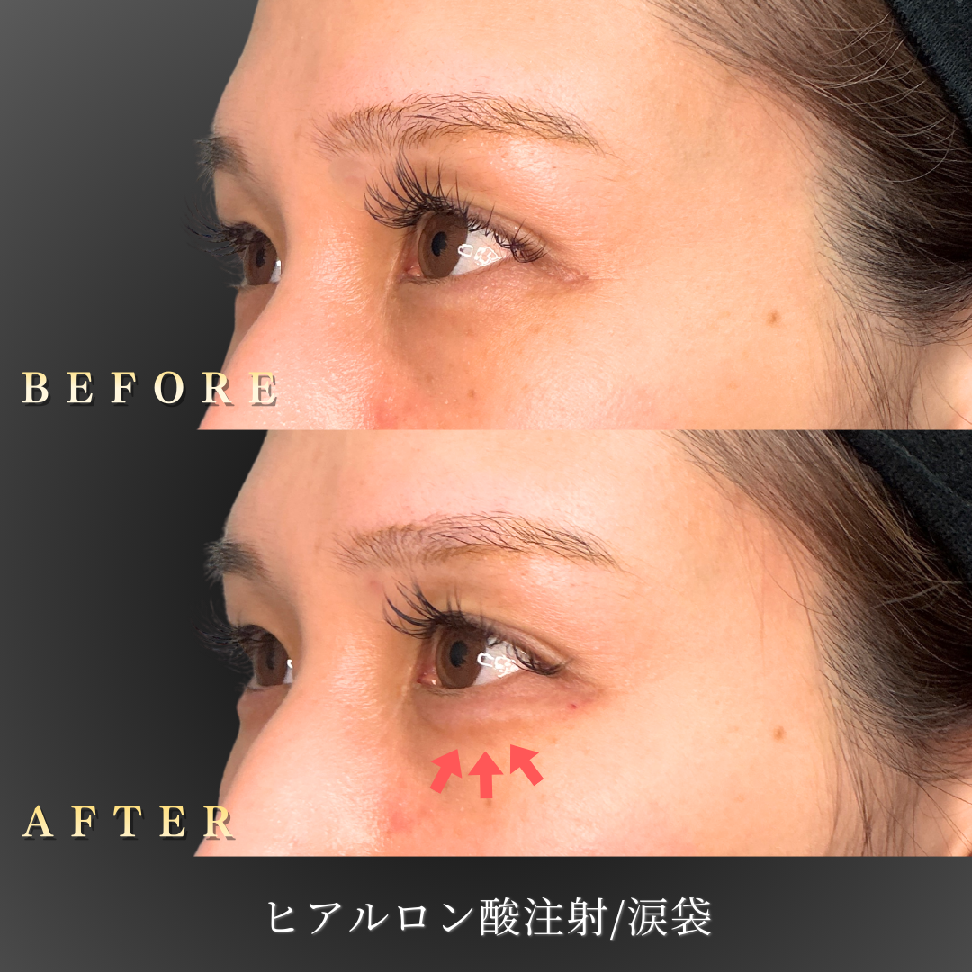 30代 涙袋ヒアルロン酸 症例写真〔左45度Before/After〕｜大阪 心斎橋BiBiクリニック