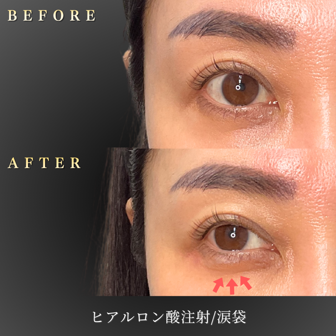 40代 涙袋ヒアルロン酸 症例写真〔正面笑顔Before/After〕｜大阪 心斎橋BiBiクリニック