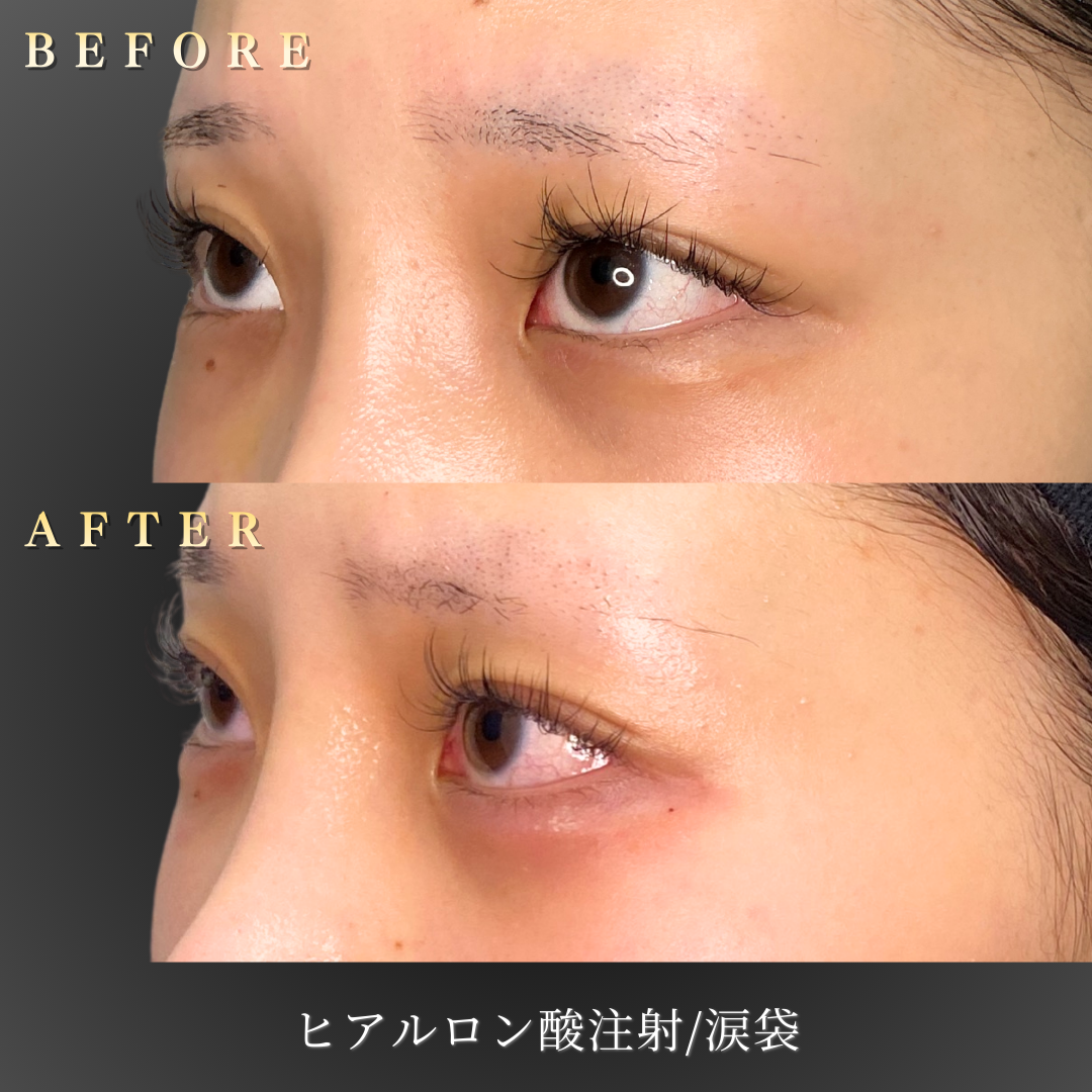 10代女性 涙袋ヒアルロン酸 症例写真〔左45度Before/After〕｜大阪 心斎橋BiBiクリニック