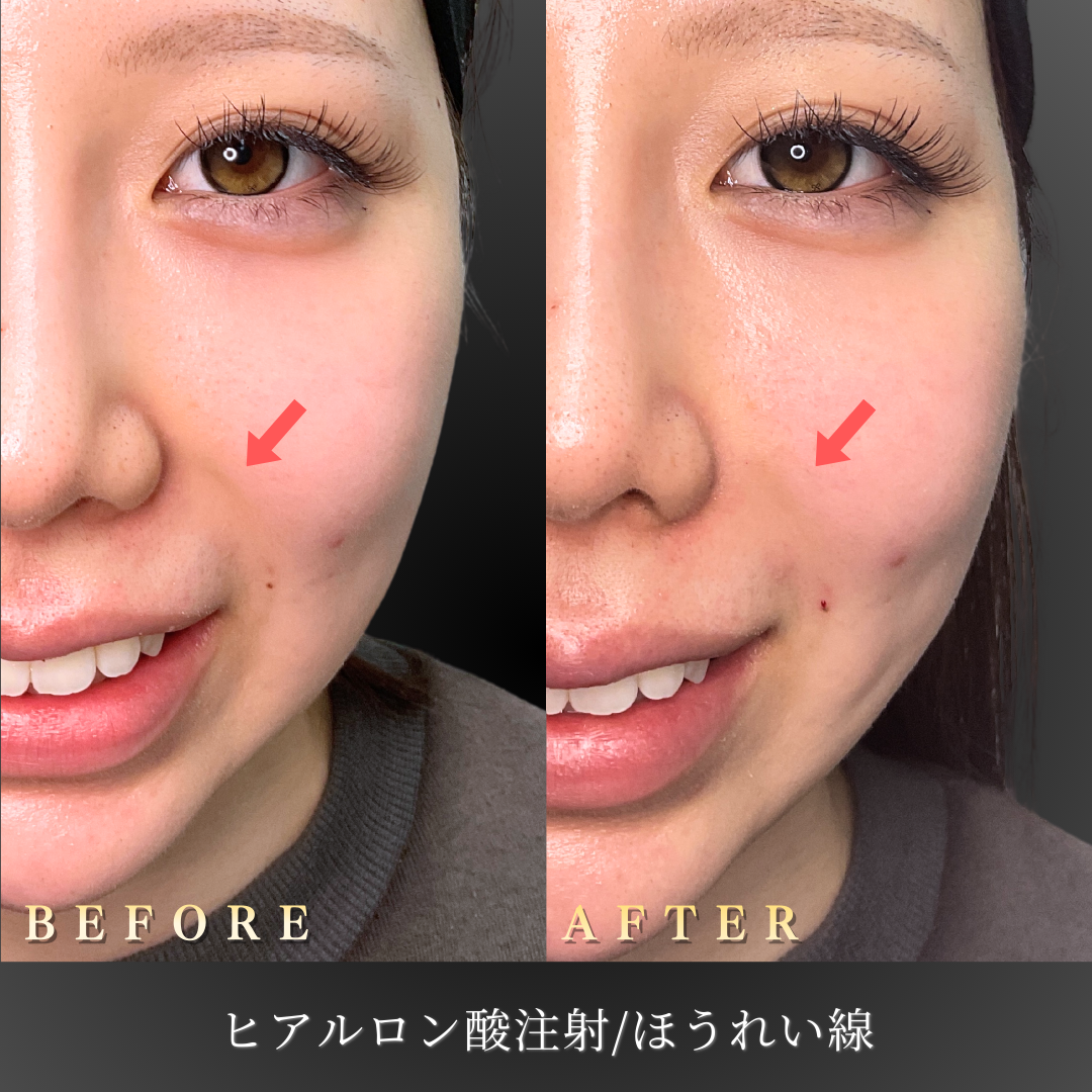 20代 ほうれい線ヒアルロン酸 症例写真〔正面笑顔Before/After〕｜大阪 心斎橋BiBiクリニック