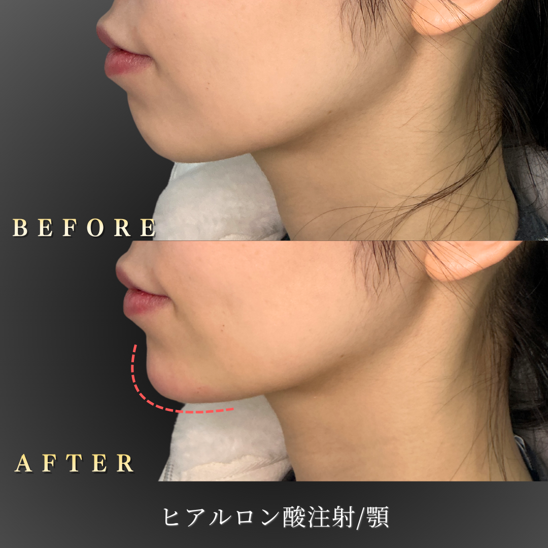 20代女性 顎ヒアルロン酸 症例写真〔左横Before/After〕｜大阪 心斎橋BiBiクリニック