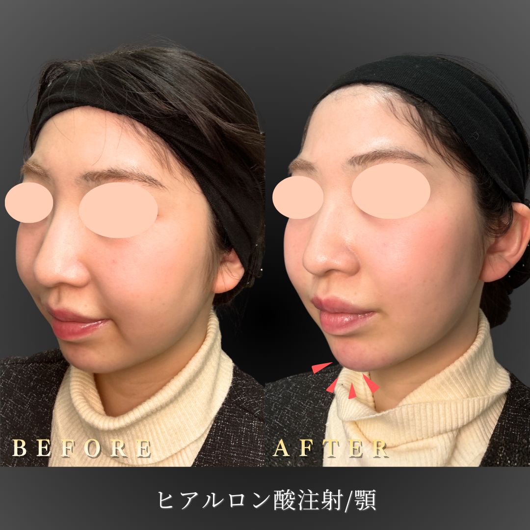 20代 顎ヒアルロン酸 症例写真〔左45度Before/After〕｜大阪 心斎橋BiBiクリニック