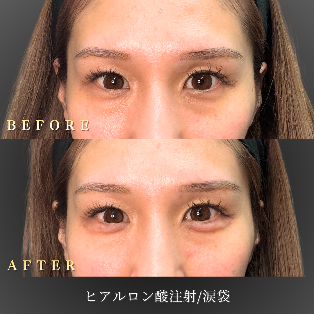 30代 涙袋ヒアルロン酸 症例写真〔正面笑顔Before/After〕｜大阪 心斎橋BiBiクリニック