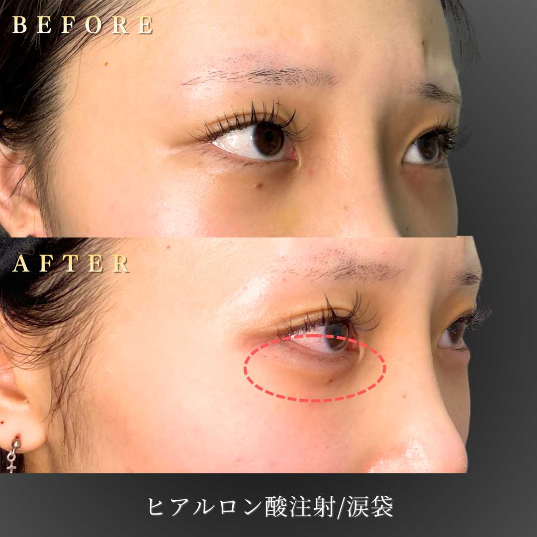 10代女性 涙袋ヒアルロン酸 症例写真〔右45度Before/After〕｜大阪 心斎橋BiBiクリニック