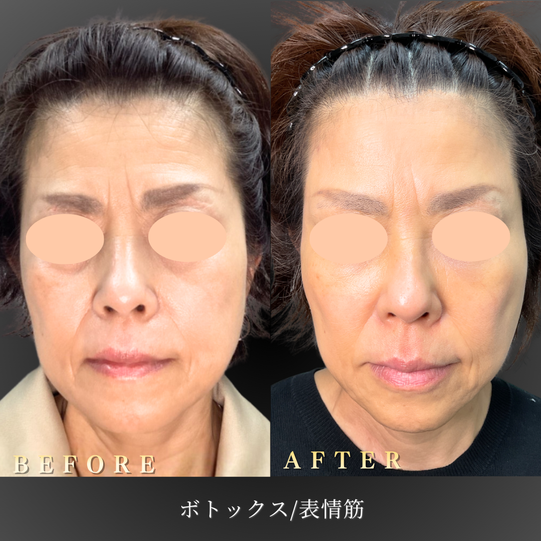 50代女性 額・眉間ボトックス 症例写真〔Before/After〕眉を上げた状態｜大阪 心斎橋BiBiクリニック