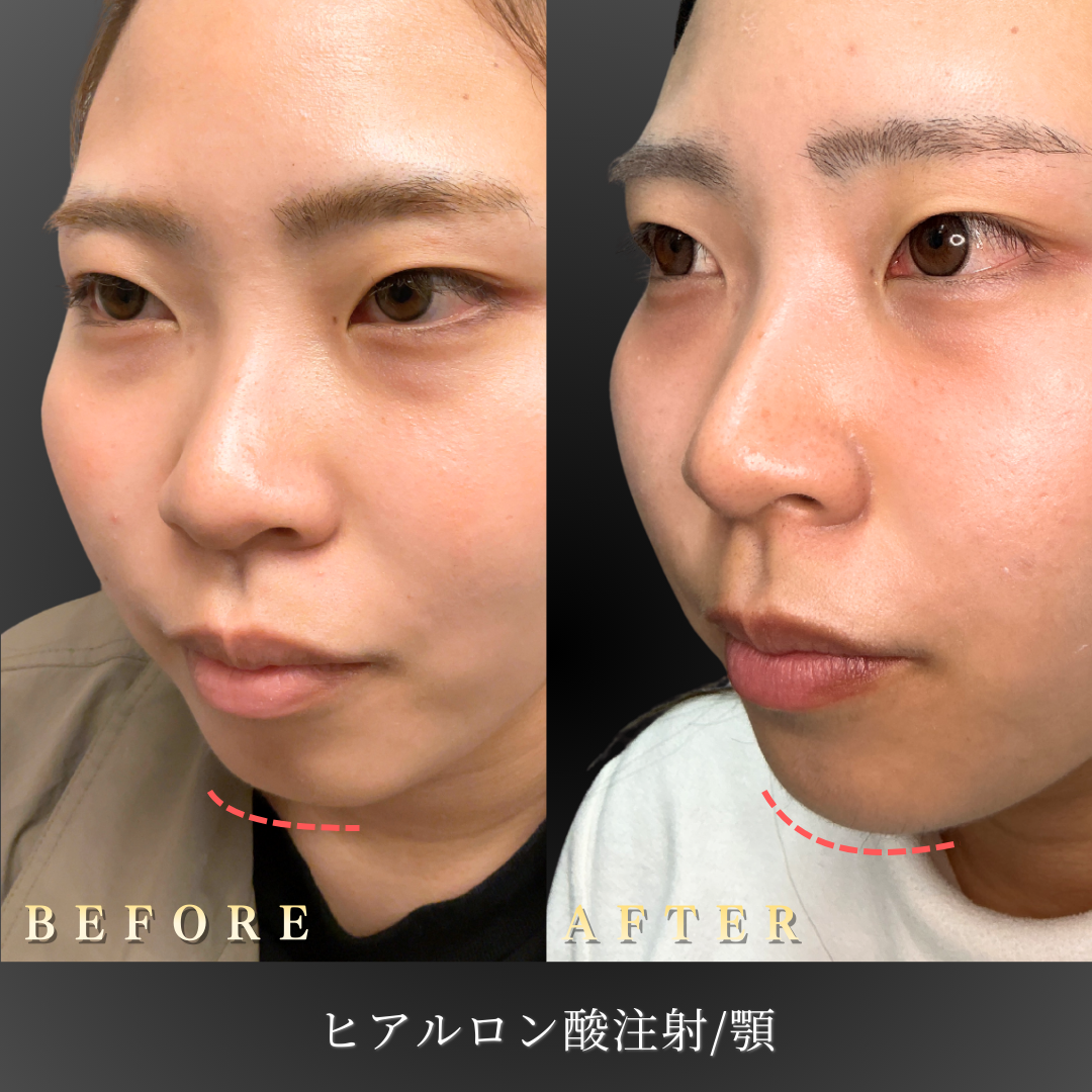 20代女性 顎ヒアルロン酸 症例写真〔左45度Before/After〕｜大阪 心斎橋BiBiクリニック