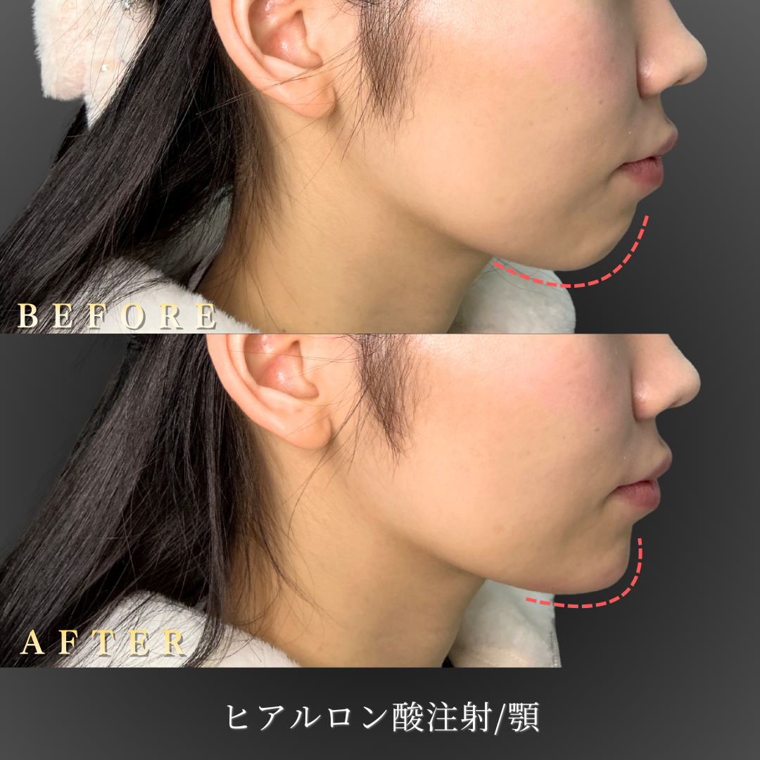 20代女性 顎ヒアルロン酸 症例写真〔右横Before/After〕｜大阪 心斎橋BiBiクリニック