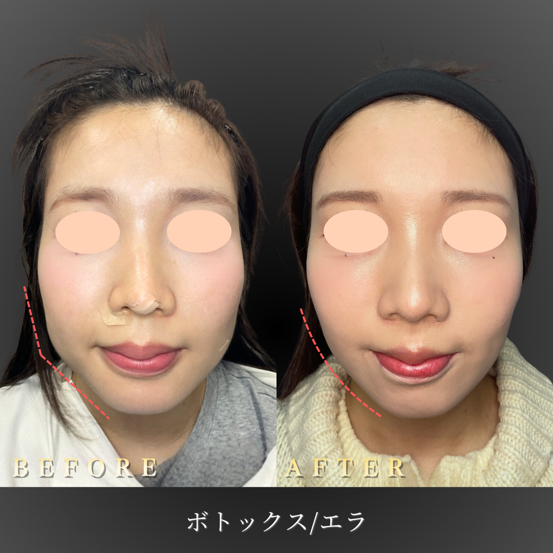 【メイン】20代 エラボトックス（食いしばり改善）症例写真〔正面Before/After〕｜大阪 心斎橋BiBiクリニック