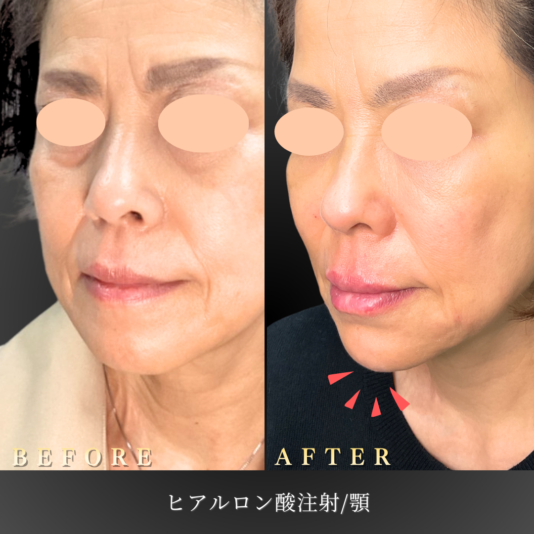 59歳女性 顎ヒアルロン酸（ボラックス2本）Before/After〔右斜め〕｜大阪 心斎橋BiBiクリニック