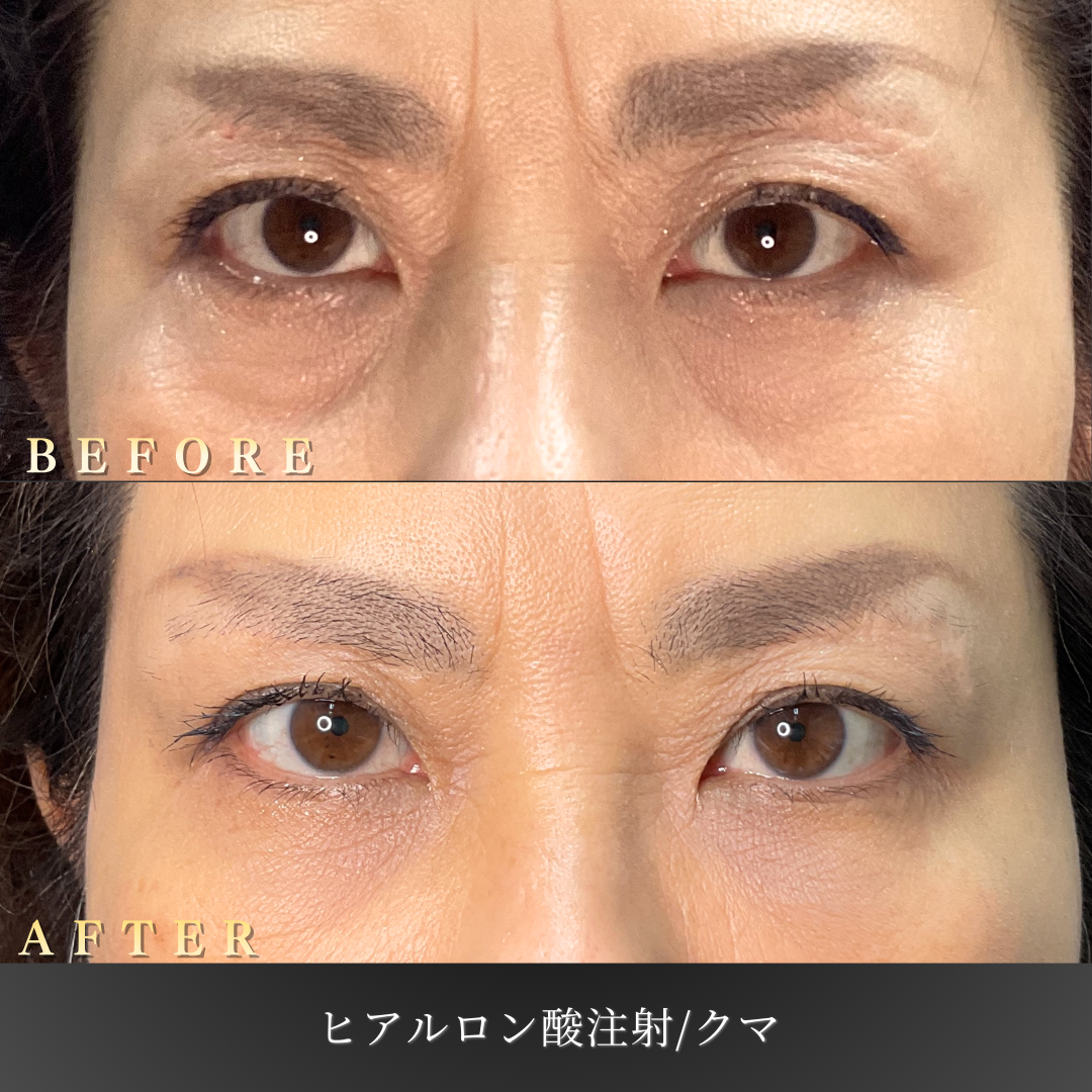 50代女性 中顔面ヒアルロン酸 症例写真〔Before/After〕｜大阪 心斎橋BiBiクリニック