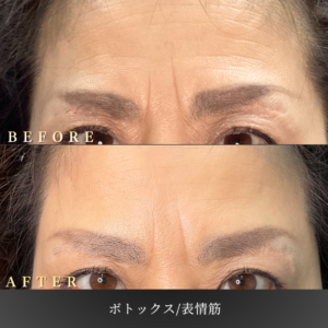 50代 表情筋ボトックス 症例写真〔正面before/after〕｜大阪 心斎橋BiBiクリニック