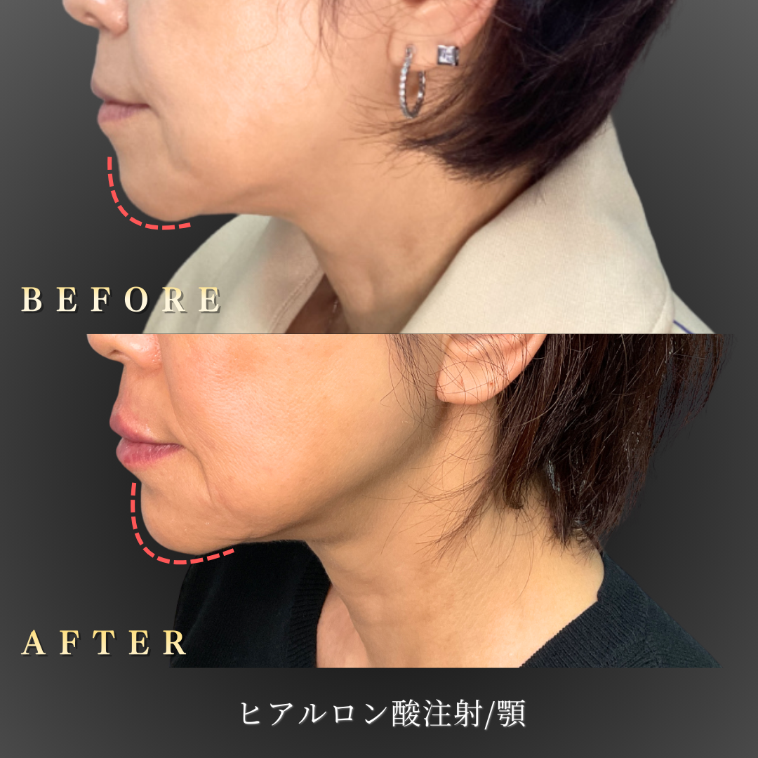 【50代女性】フェイスラインの崩れを整える顎ヒアルロン酸症例｜大阪 心斎橋BiBiクリニックの症例写真
