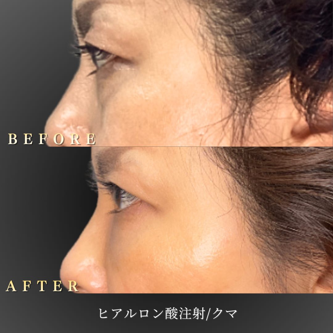 50代女性 中顔面ヒアルロン酸 症例写真〔別角度〕｜大阪 心斎橋BiBiクリニック