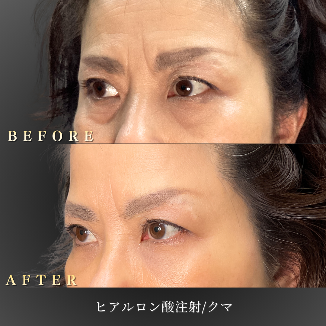 【50代女性】若々しい目元を取り戻す中顔面ヒアルロン酸症例｜大阪 心斎橋BiBiクリニックの症例写真