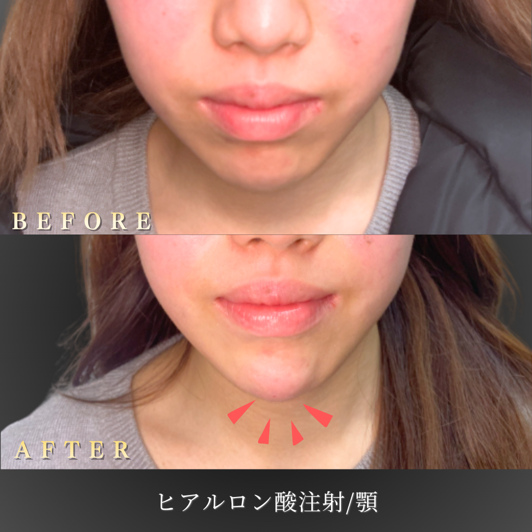 【10代女性】Eラインを意識した顎ヒアルロン酸症例｜大阪 心斎橋BiBiクリニックの症例写真