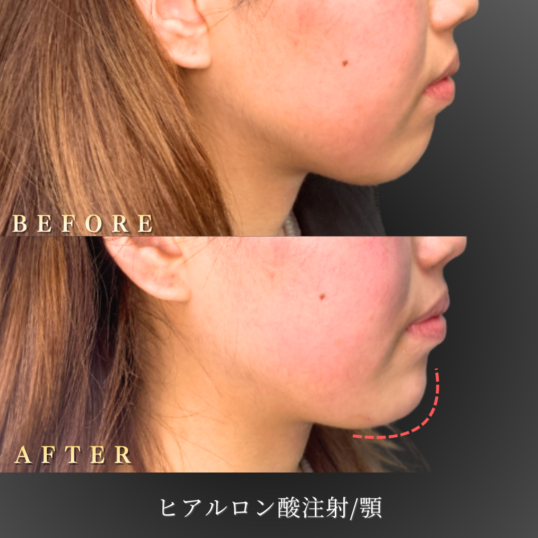 10代女性の顎ヒアルロン酸症例 シャープな輪郭形成