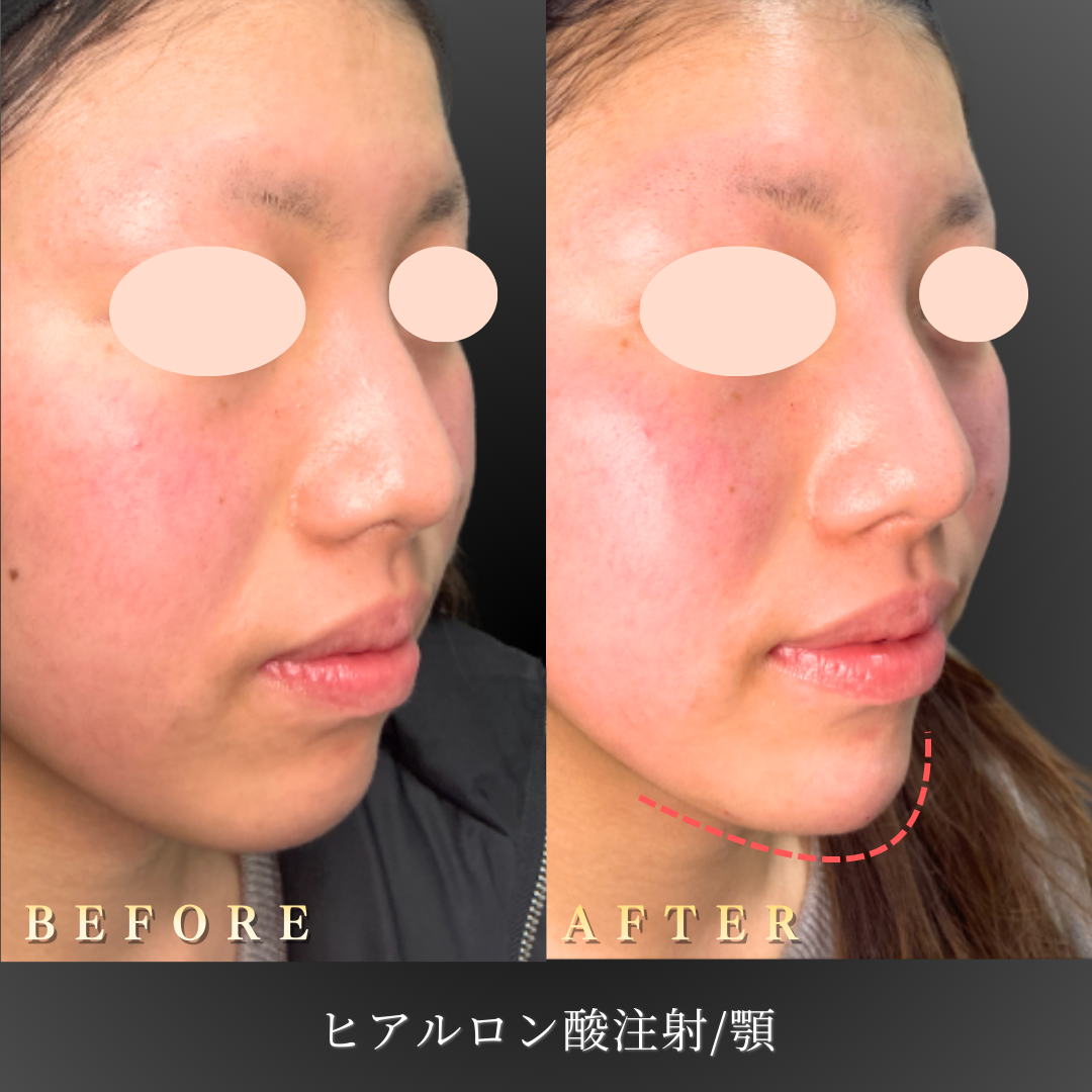 10代女性の顎ヒアルロン酸症例 正面からのシャープな輪郭形成