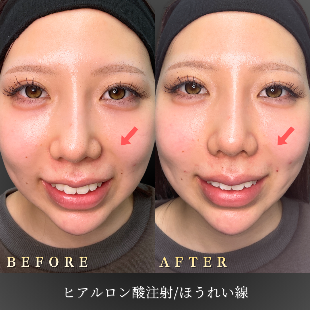20代 ほうれい線ヒアルロン酸 症例写真〔正面笑顔Before/After〕｜大阪 心斎橋BiBiクリニック