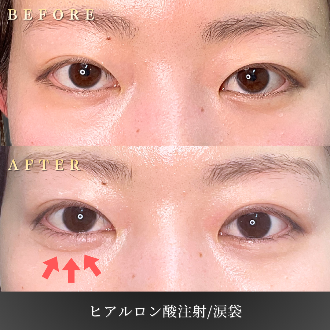 【20代女性】ぷっくりしすぎない涙袋ヒアルロン酸症例｜大阪 心斎橋BiBiクリニックの症例写真