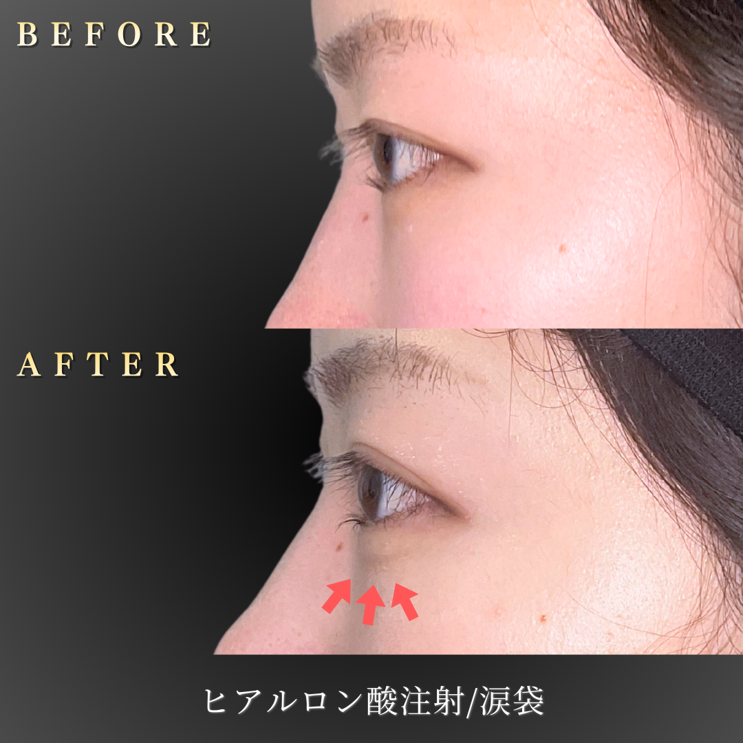 20代女性の涙袋ヒアルロン酸注入後の目元アップ写真