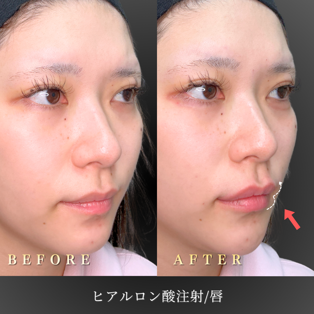 【20代女性】素の唇を活かすリップヒアルロン酸症例｜大阪 心斎橋BiBiクリニックの症例写真