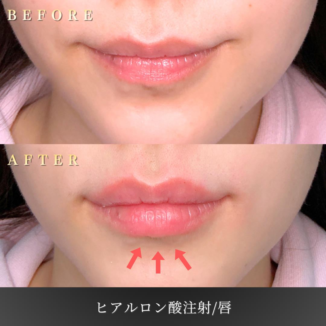 20代女性 唇ヒアルロン酸 症例写真〔Before/After〕｜大阪 心斎橋BiBiクリニック