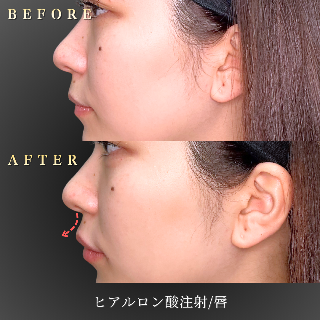 20代女性 唇ヒアルロン酸 Before/After 正面｜大阪 心斎橋BiBiクリニック