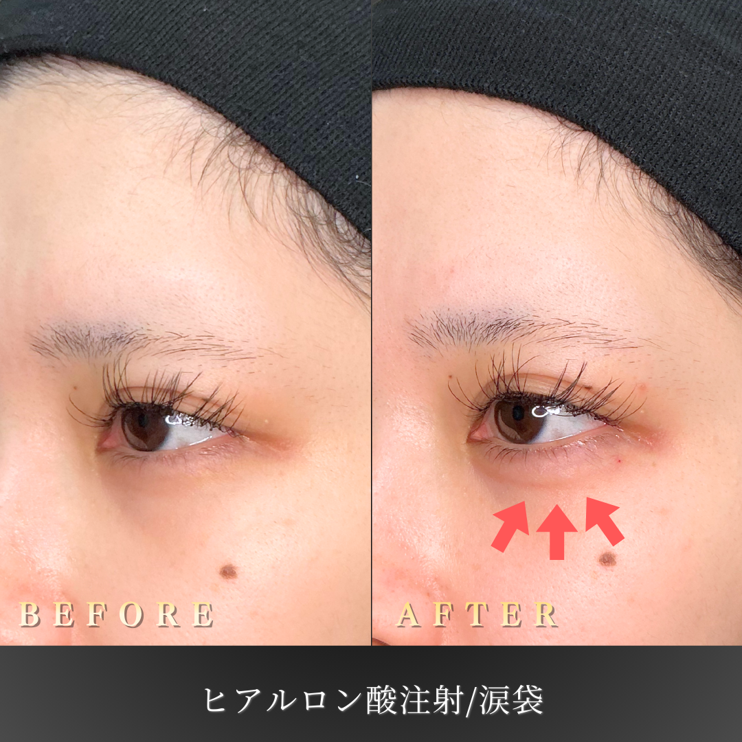 20代女性の涙袋施術前の目元写真
