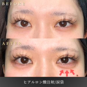 20代 涙袋ヒアルロン酸 症例写真〔正面Before/After〕｜大阪 心斎橋BiBiクリニック