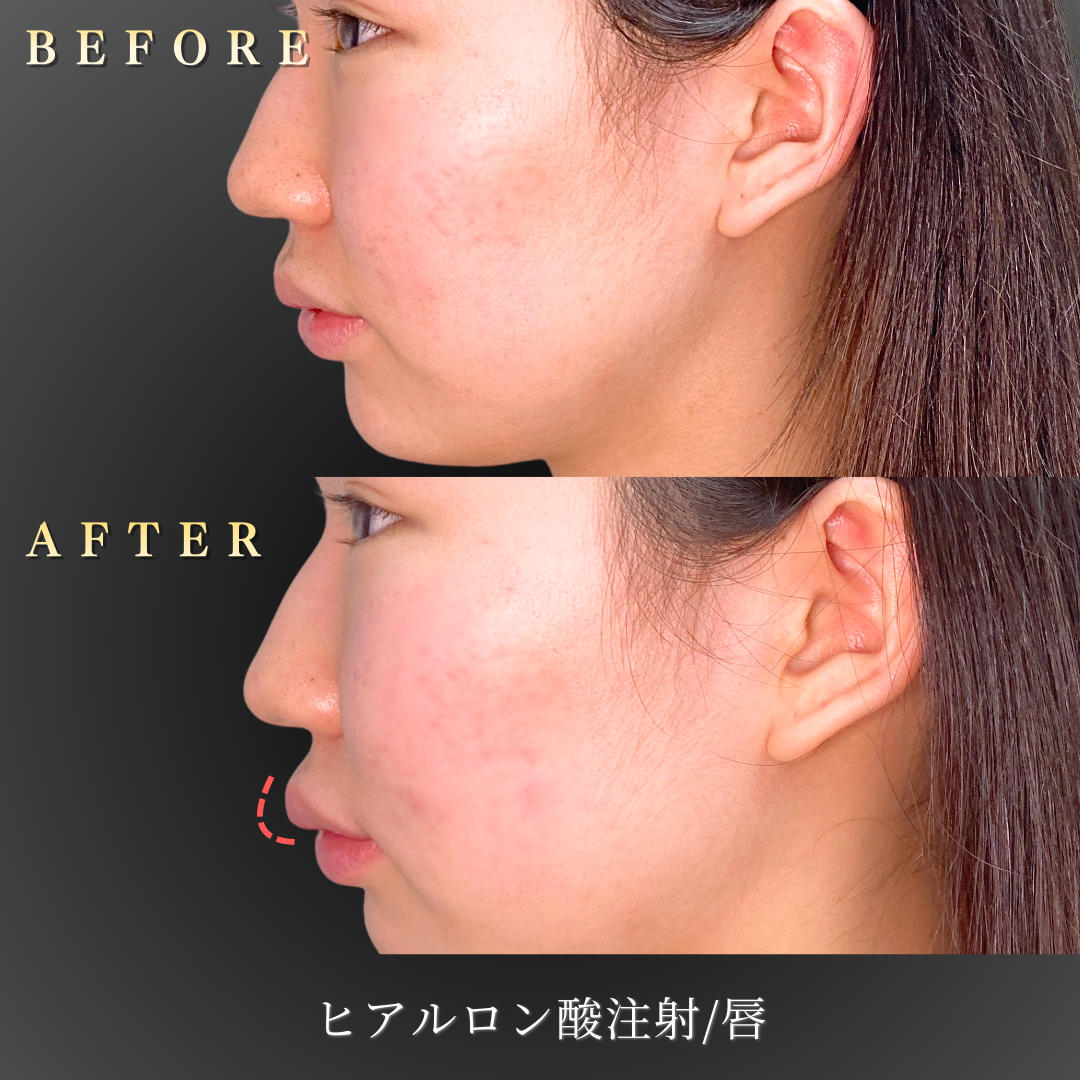 10代女性 リップヒアルロン酸 症例写真〔正面笑顔Before/After〕｜大阪 心斎橋BiBiクリニック