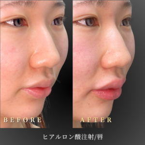 20代 唇ヒアルロン酸 症例写真〔右45度Before/After〕｜大阪 心斎橋BiBiクリニック