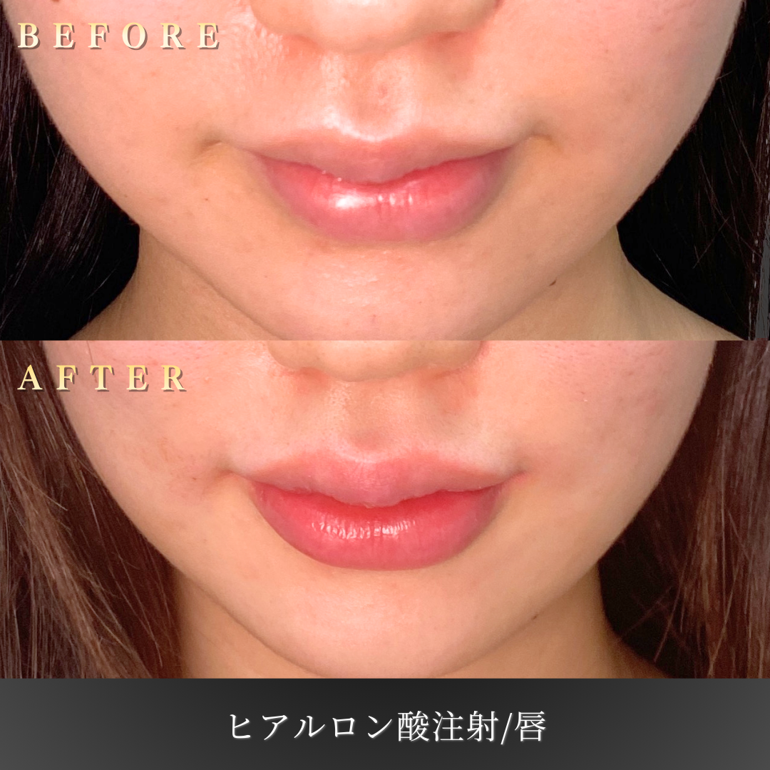 10代女性 リップヒアルロン酸 症例写真〔Before/After〕｜大阪 心斎橋BiBiクリニック