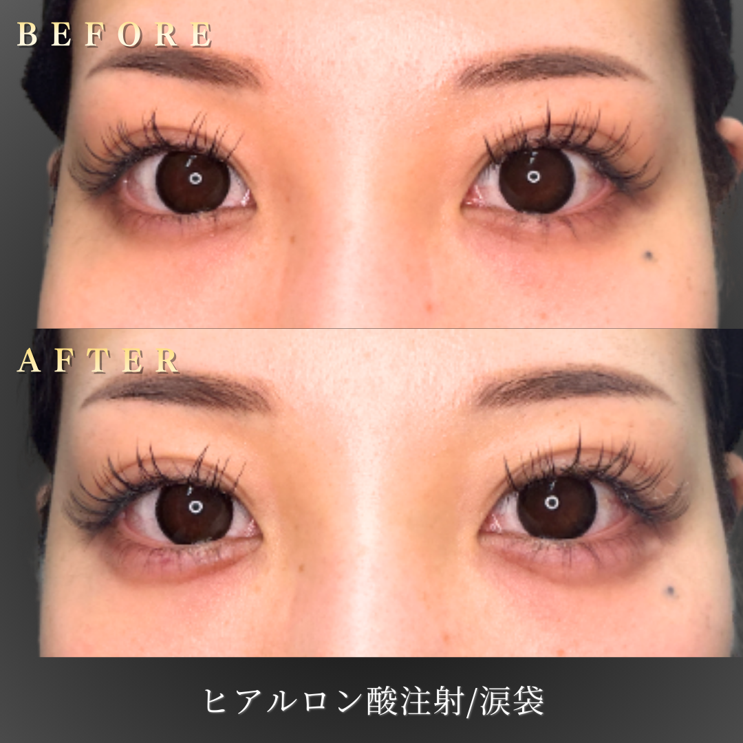 【20代女性】自然な立体感を足す涙袋ヒアルロン酸症例｜大阪 心斎橋BiBiクリニックの症例写真