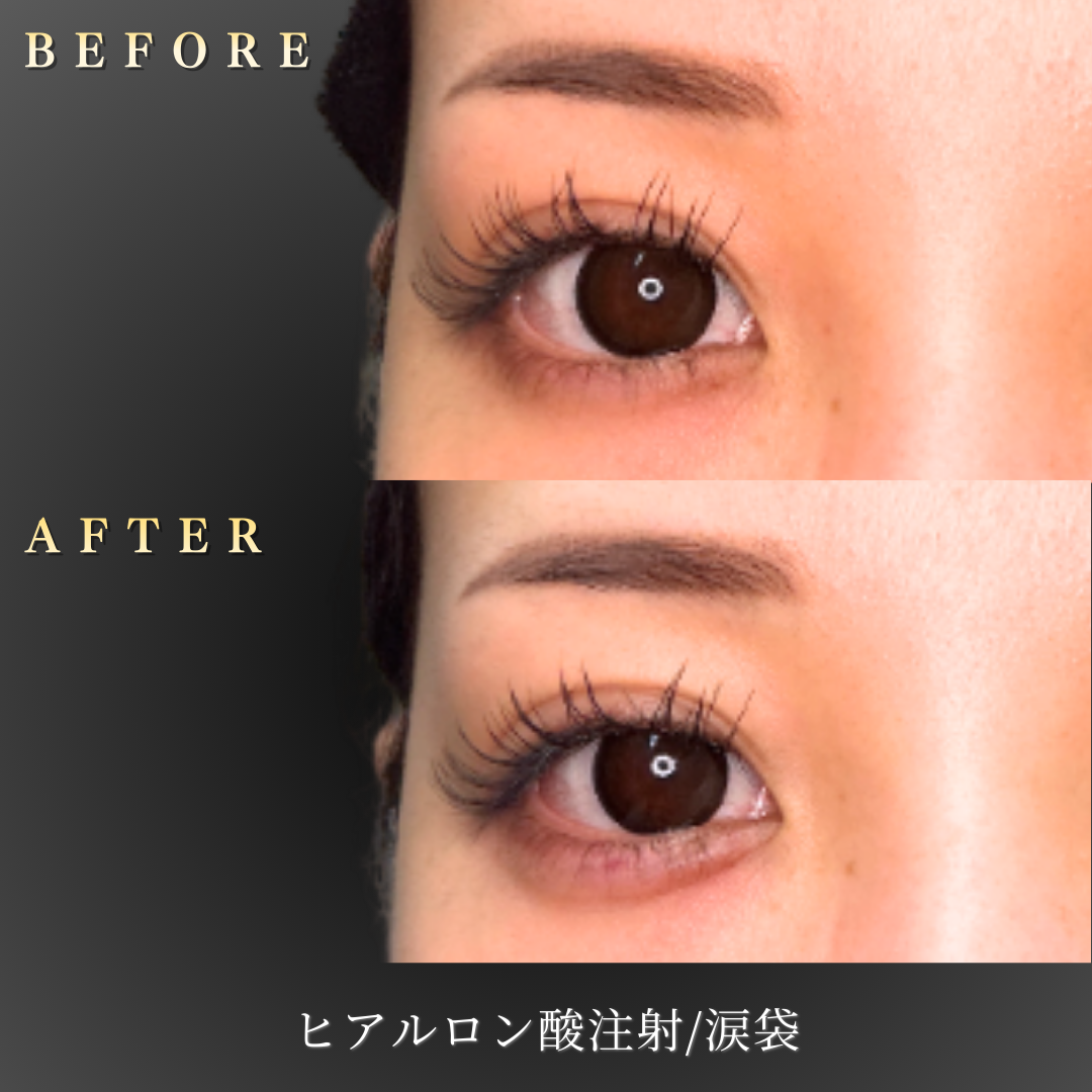 20代 涙袋ヒアルロン酸 症例写真〔笑顔Before/After〕｜大阪 心斎橋BiBiクリニック