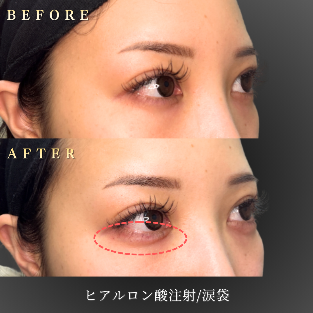 20代 涙袋ヒアルロン酸 症例写真〔右45度Before/After〕｜大阪 心斎橋BiBiクリニック