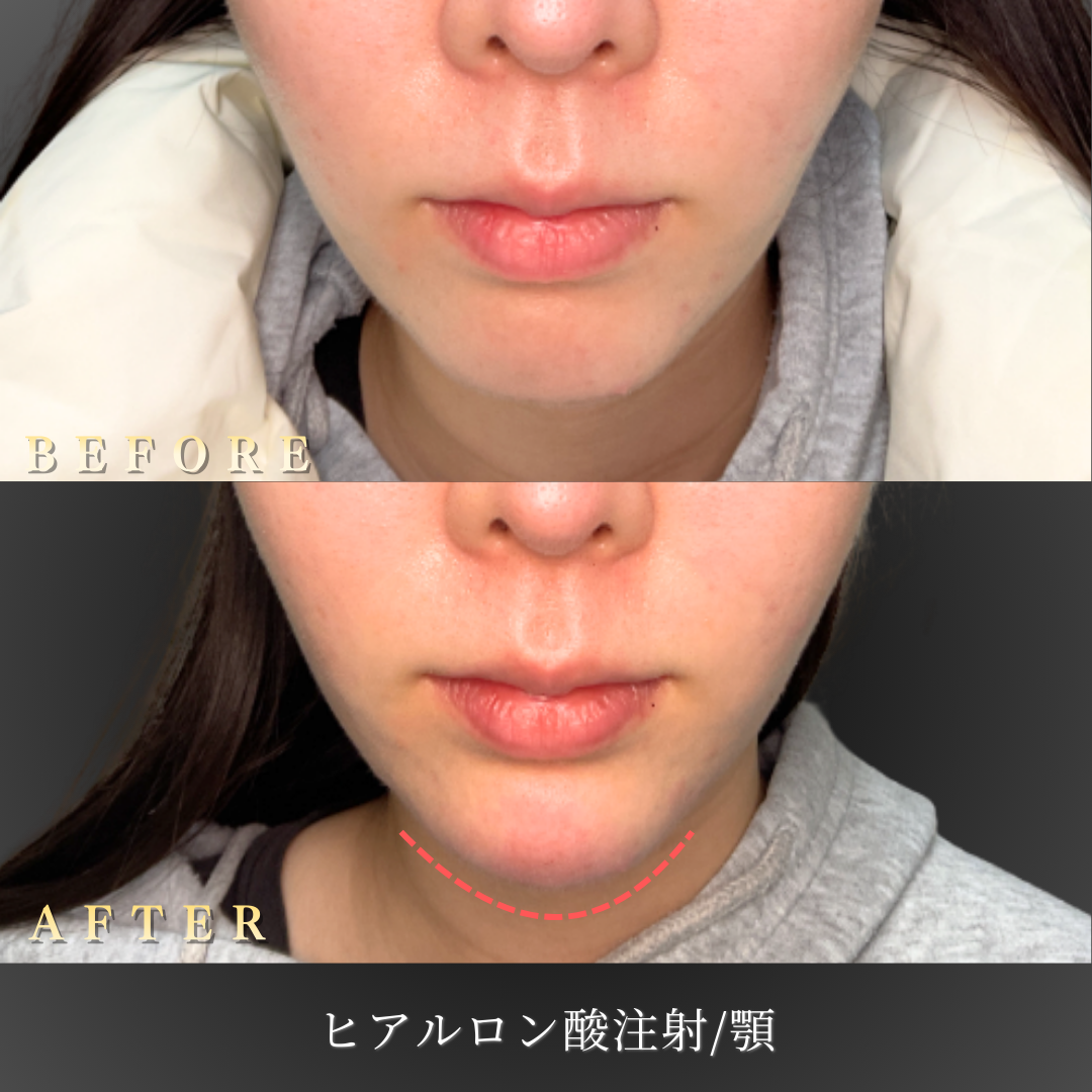 20代女性 顎ヒアルロン酸 症例写真〔正面Before/After〕｜大阪 心斎橋BiBiクリニック